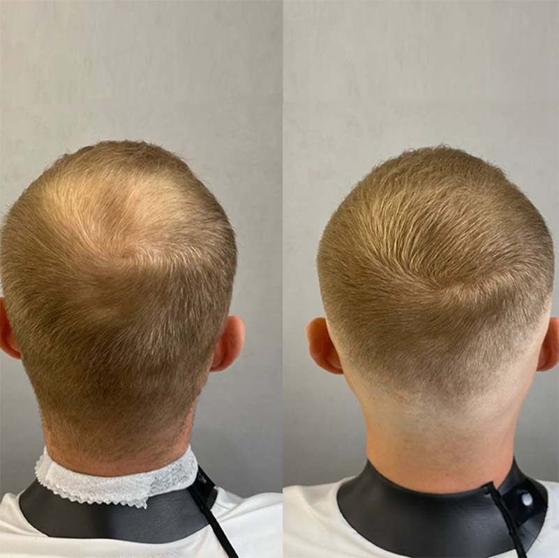 Preenchedor de Fibra Capilar – Cobre Falhas com Volume Natural